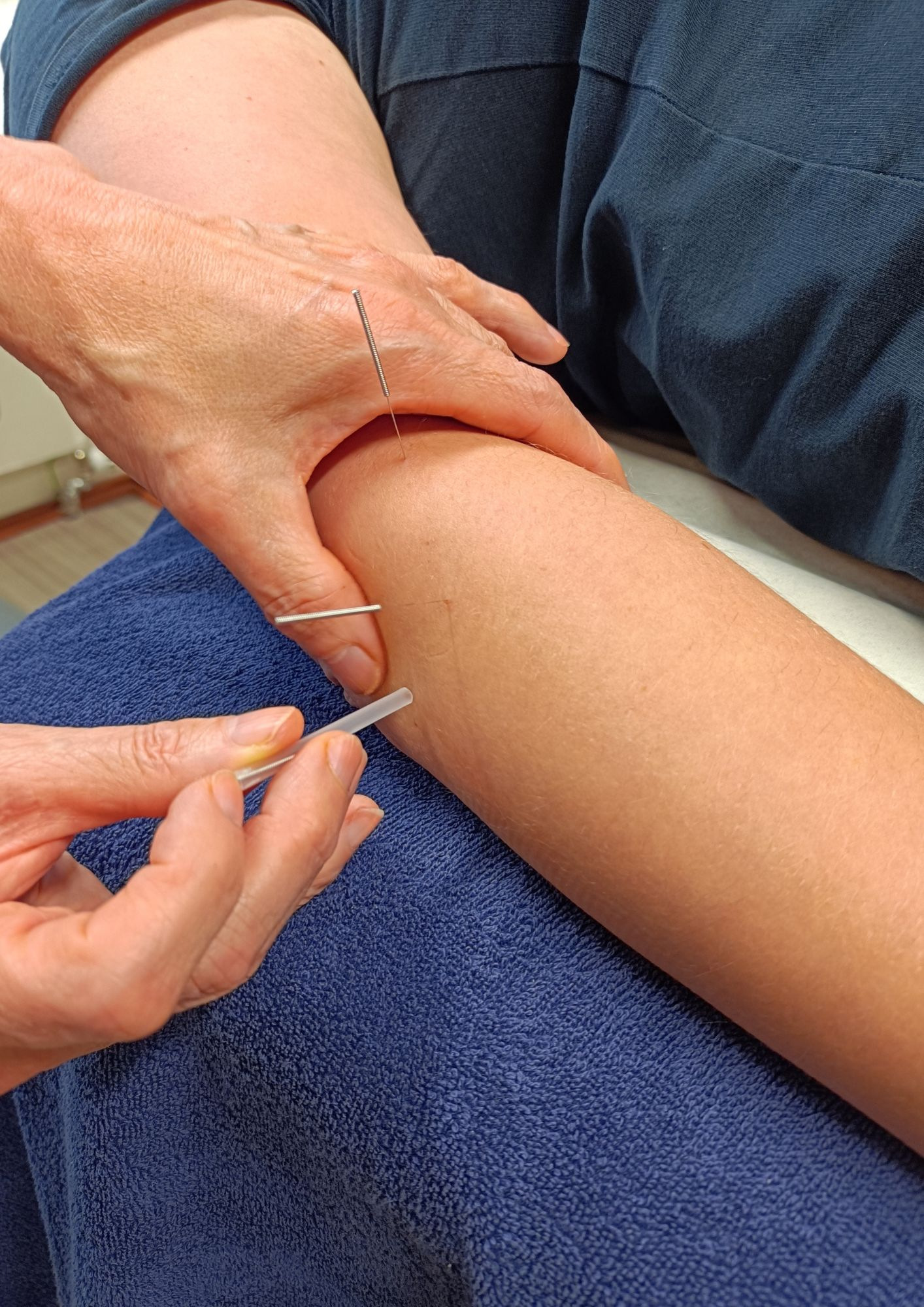 Kyynärvarren Dry Needling -käsittely