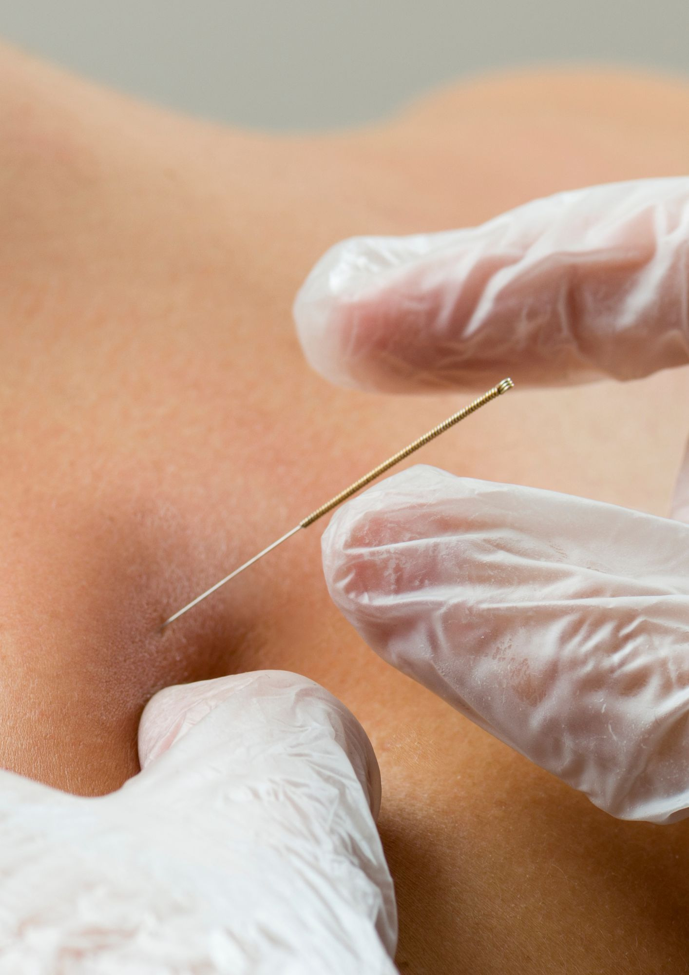 Dry Needling -neula asetetaan olkapään alueelle